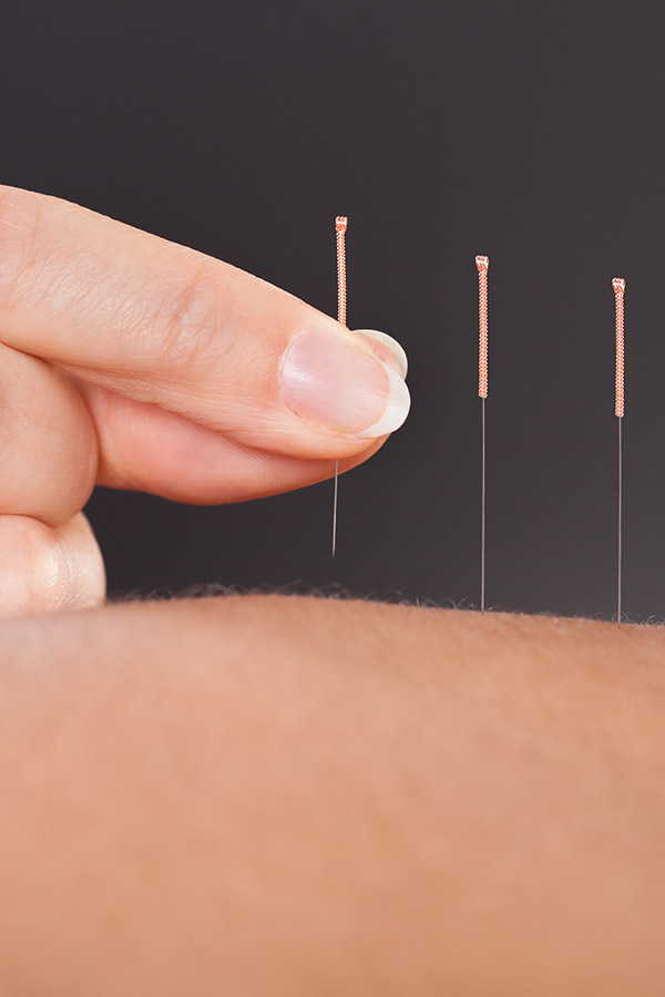 Acupuncture Needles